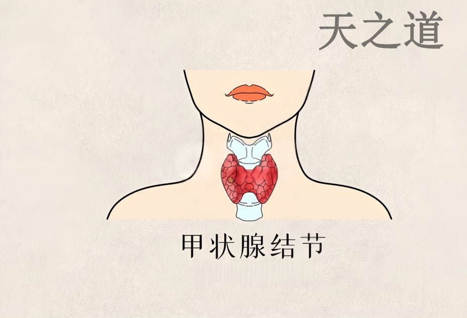爱长结节的人，身上有一个共同点！打开气血开关、破除全身瘀结！